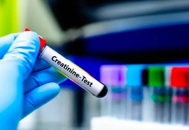 Creatinine Levels