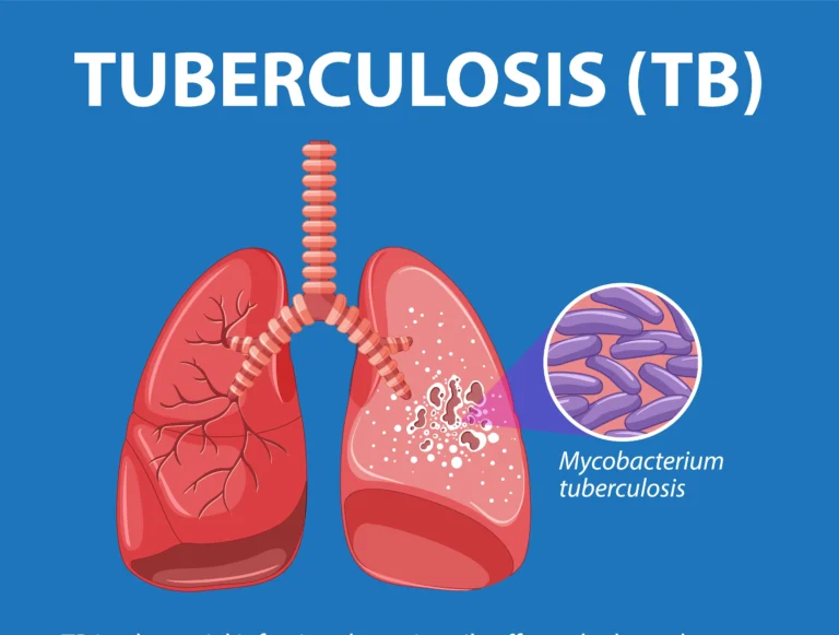 Tuberculosis (TB) Test